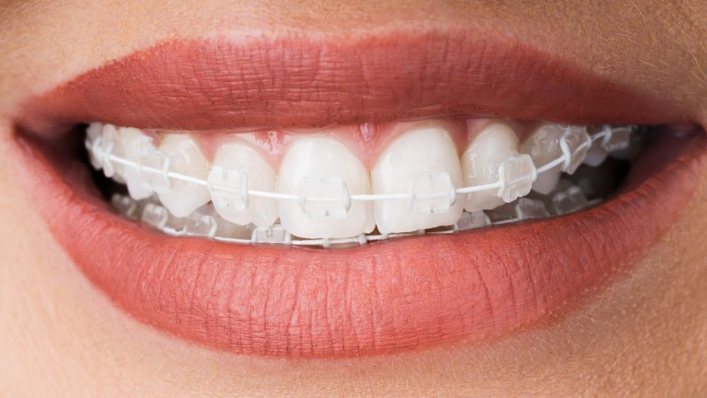 Primer plano de la sonrisa de una persona que lleva ortodoncia de cerámica.