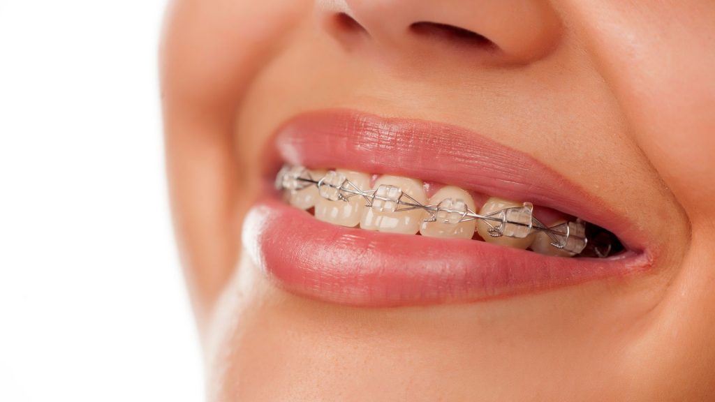 Primer plano de la boca de una mujer sonriente que lleva ortodoncia de cerámica.