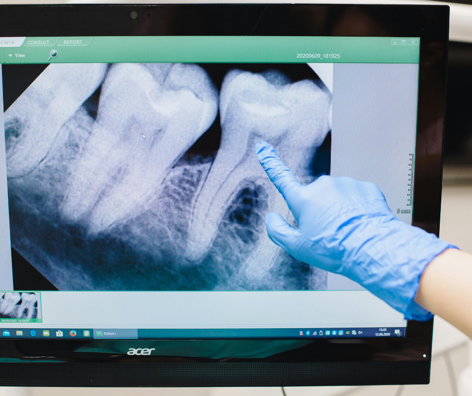 Una mano enguantada señala la radiografía de un diente en la pantalla de un ordenador.