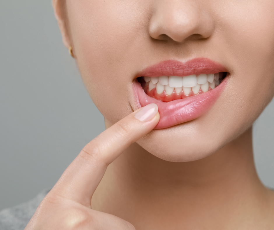 Una mujer se tira del labio inferior hacia abajo para mostrar unas encías inflamadas