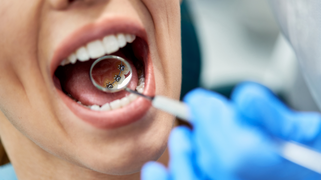 A hand holding a small mirror inside the mouth of a patient with lingual braces