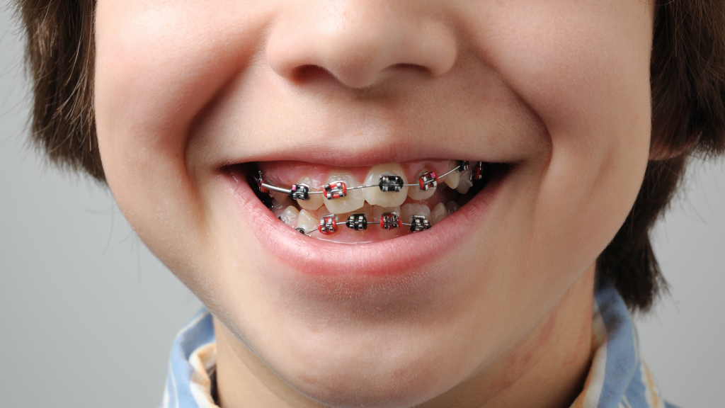 The lower half of the face of a smiling child with crooked teeth wearing braces