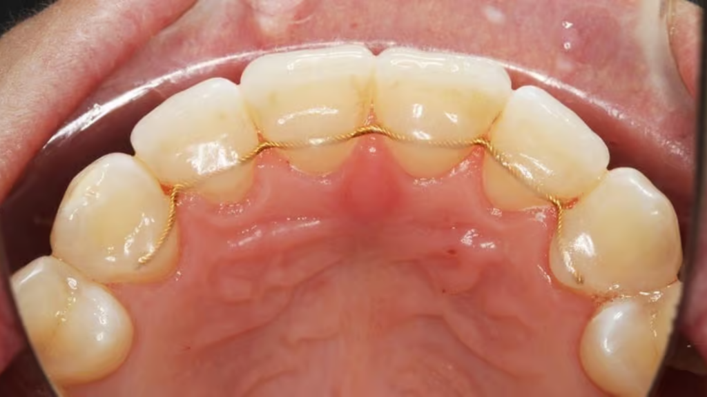 The back of a person's teeth with a wire retainer cemented on