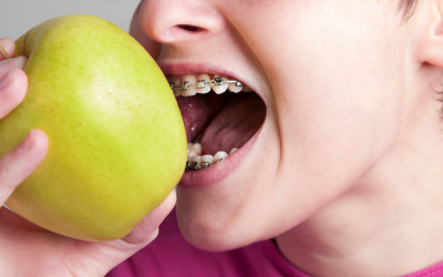 What to Eat With Braces or Clear Aligners: Ultimate Guide