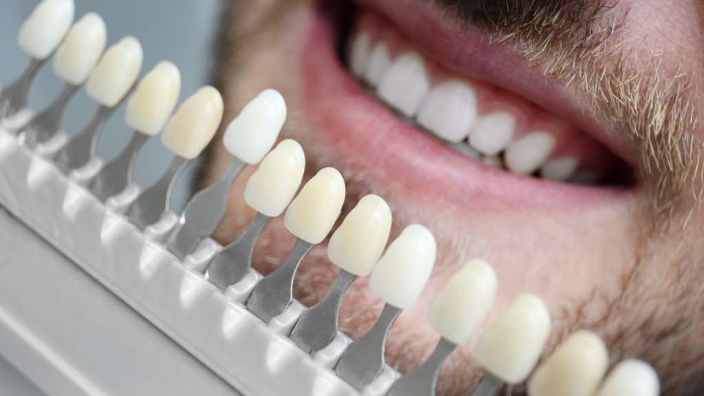 la mitad inferior del rostro de un hombre sonriente detrás de una selección de diferentes colores de dientes utilizados para hacer carillas dentales.
