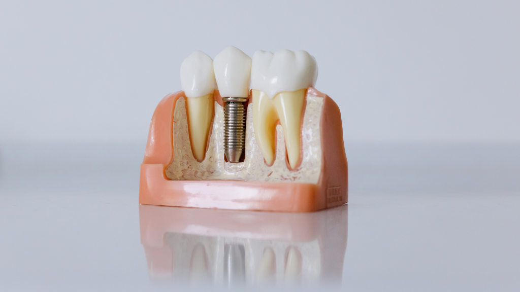 A model of three teeth in a gumline showing the cross section of the jaw bone and tooth roots with one of the teeth as a dental implant