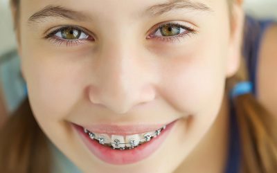 5 Things to Expect After Having Your Braces Removed