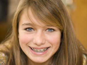 5 Possible Signs That It's Time to Get Braces
