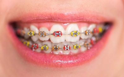 Make a Fashion Statement this Halloween with Colored Braces