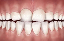 Misaligned Teeth in Kids